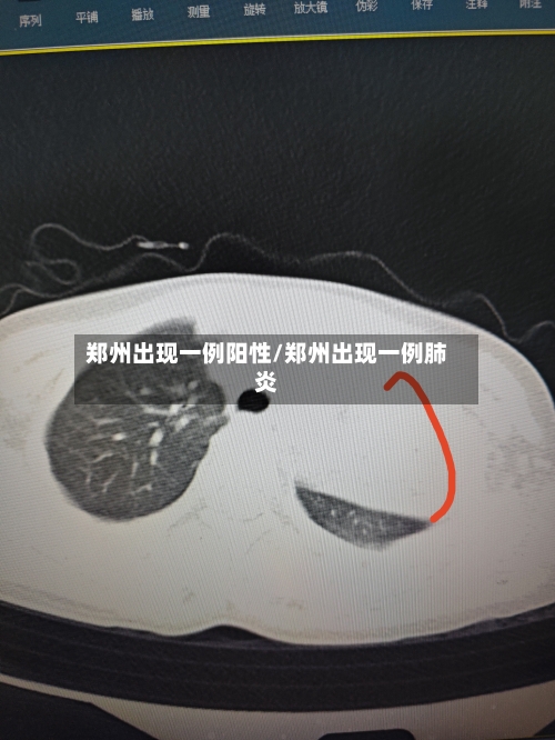 郑州出现一例阳性/郑州出现一例肺炎-第2张图片